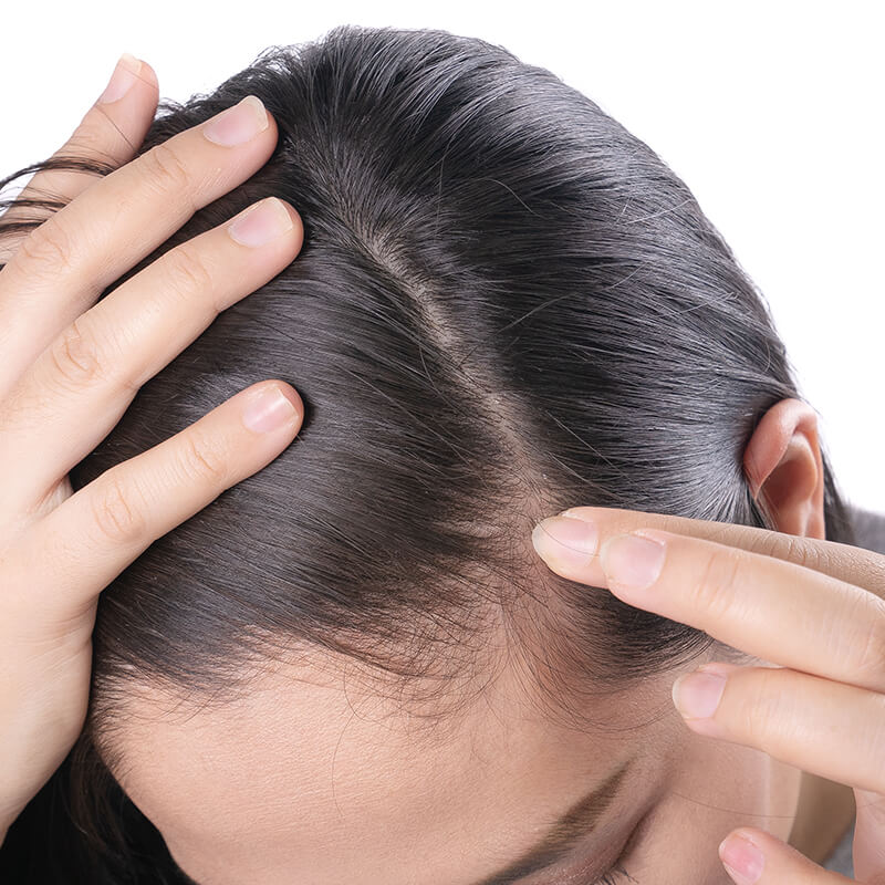 Behandlung gegen Haarausfall - Hautarzt Villach